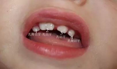 牙齿长成包谷牙怎么办,牙齿长成了双排牙如何矫正