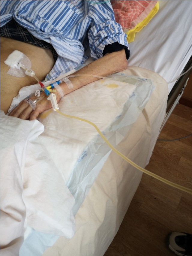 中西医结合治疗原因不明肠梗阻、腹水转氨酶明显升高病案一例！