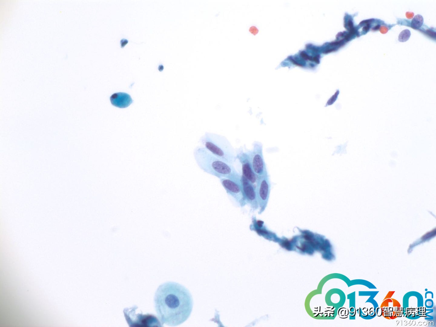 宫颈病理tct是什么检查,tct出现ascus会是宫颈癌吗