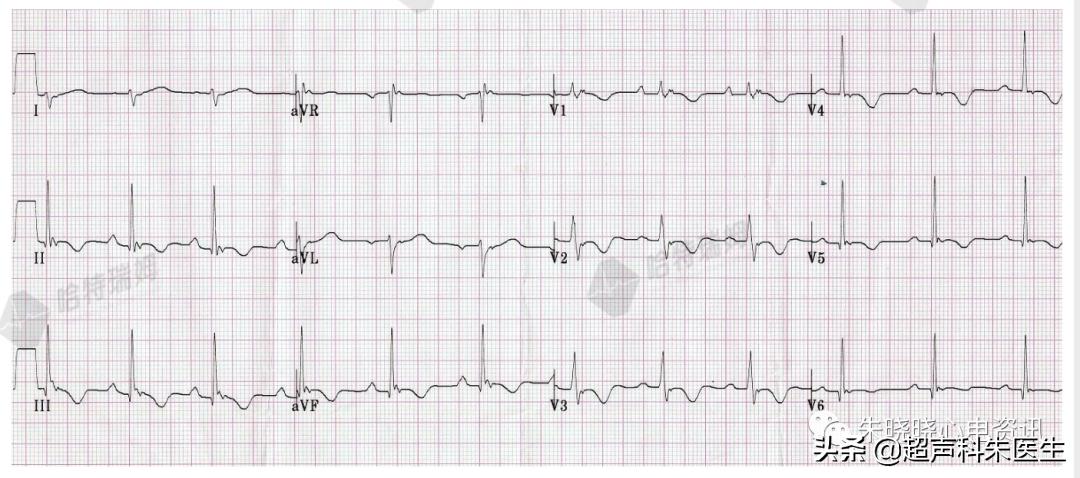 t波倒置9个真相图解,t波倒置判断口诀