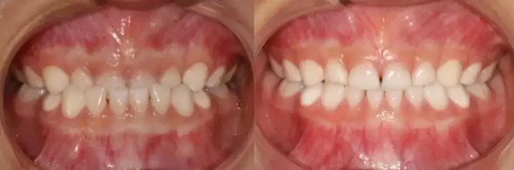 动画模拟牙齿矫正前后会变美,做了矫正牙齿会反弹吗