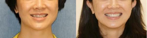 雅悦齿科,做了牙齿矫正容易得牙龈萎缩吗