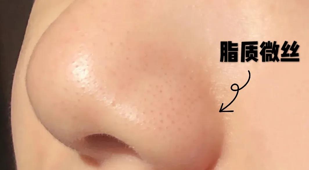 一招教你轻松去黑头,黑头去除小妙招明星