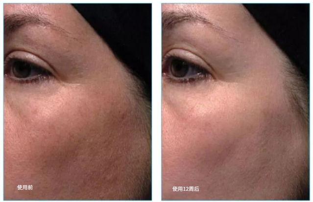 脖子被太阳晒黑了怎么才能变白,被太阳晒黑怎样变白女生