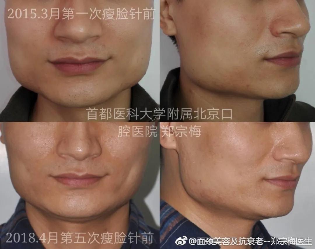 关于瘦脸的知识,关于瘦脸针