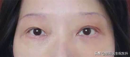 提眉术的优点及缺点,提眉术的10大问题