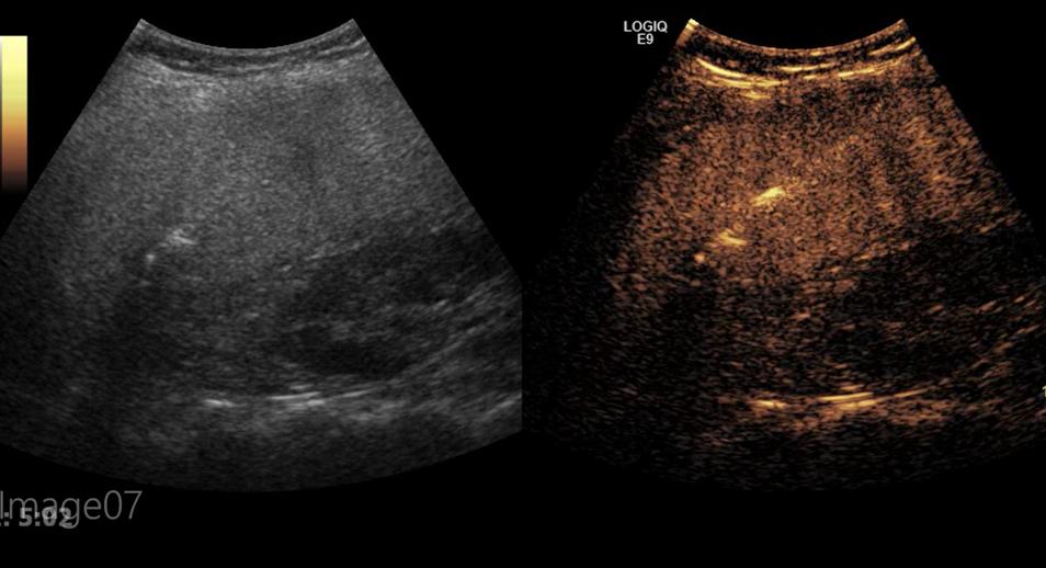 胃癌转移肝介入治疗有疗效吗,胃癌转移到肝脏做靶向治疗