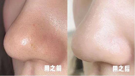 黑头毛孔粗大变细腻,皮肤黑头多毛孔大油脂分泌旺盛