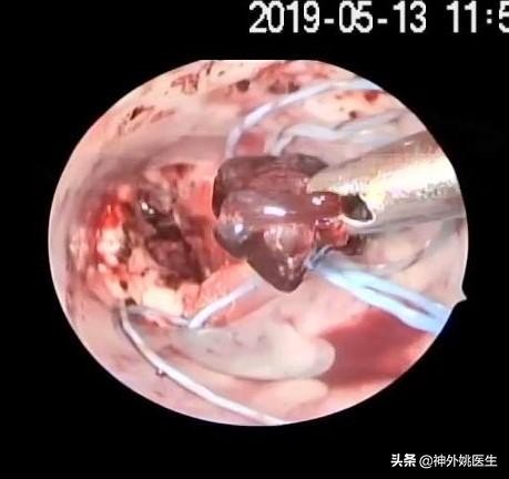 球囊扩张血肿怎么办,经皮穿刺脑血管腔内球囊成形术