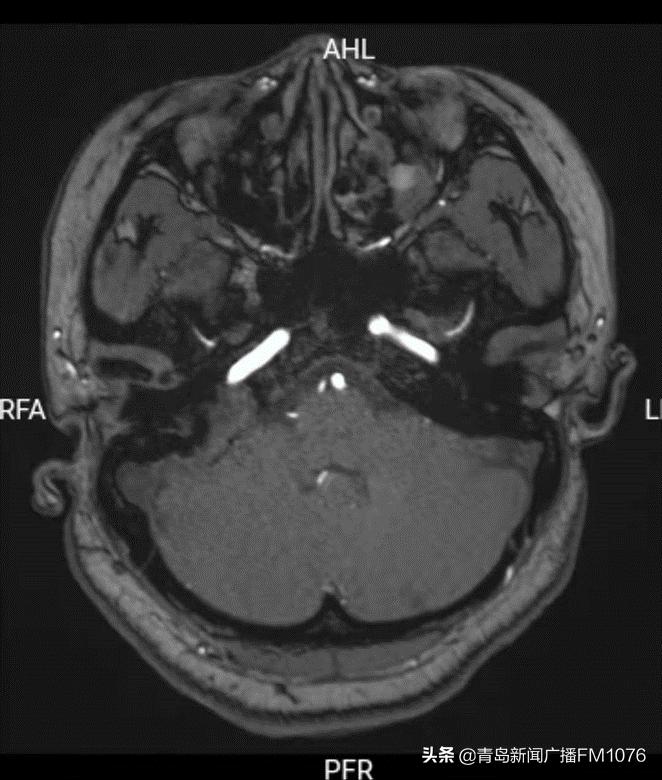 大妈脸不停抽搐，原是耳朵里藏了个大肿瘤，市立专家挑战高难度走位巧摘瘤