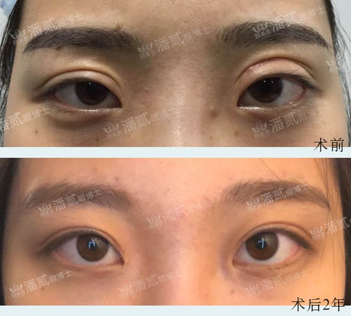 欧式大双眼皮和平行双眼皮,醒醒吧明智的放弃胜过盲目的执着