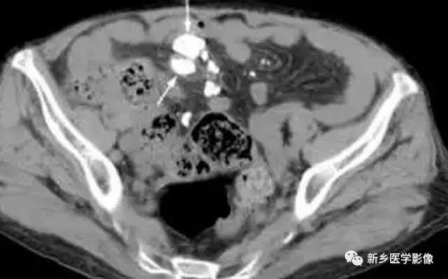 腹部平片可以看出肠胃疾病吗,腹部散在结节状高密度影