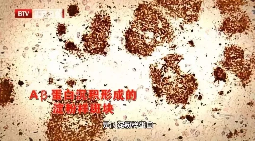 爱忘事前兆,养脑抗衰