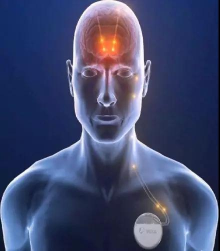 骶神经刺激器植入术效果,全面开展神经调控技术