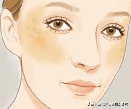 褐斑有什么症状,褐斑怎么治才能彻底消除