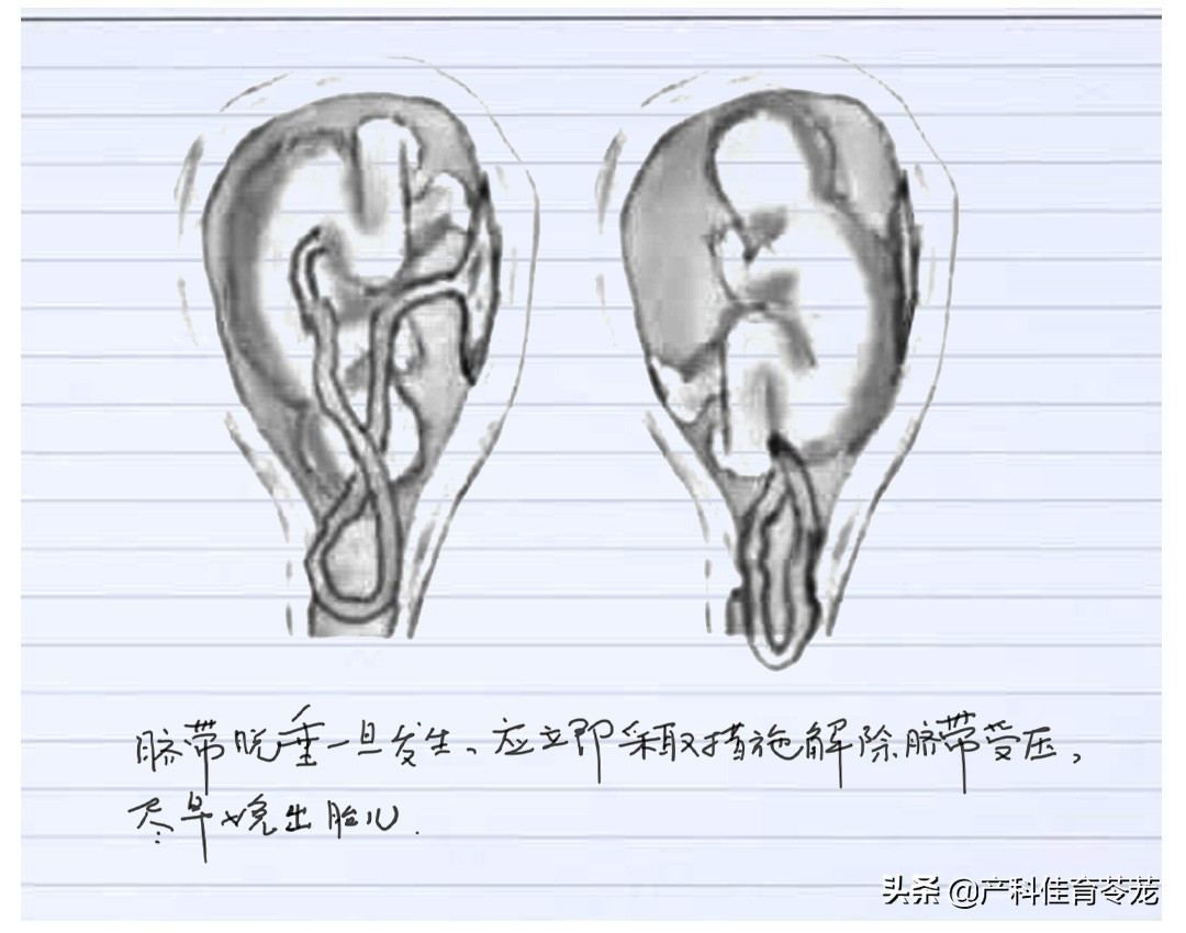 脐带脱垂,破水以后最害怕的事儿