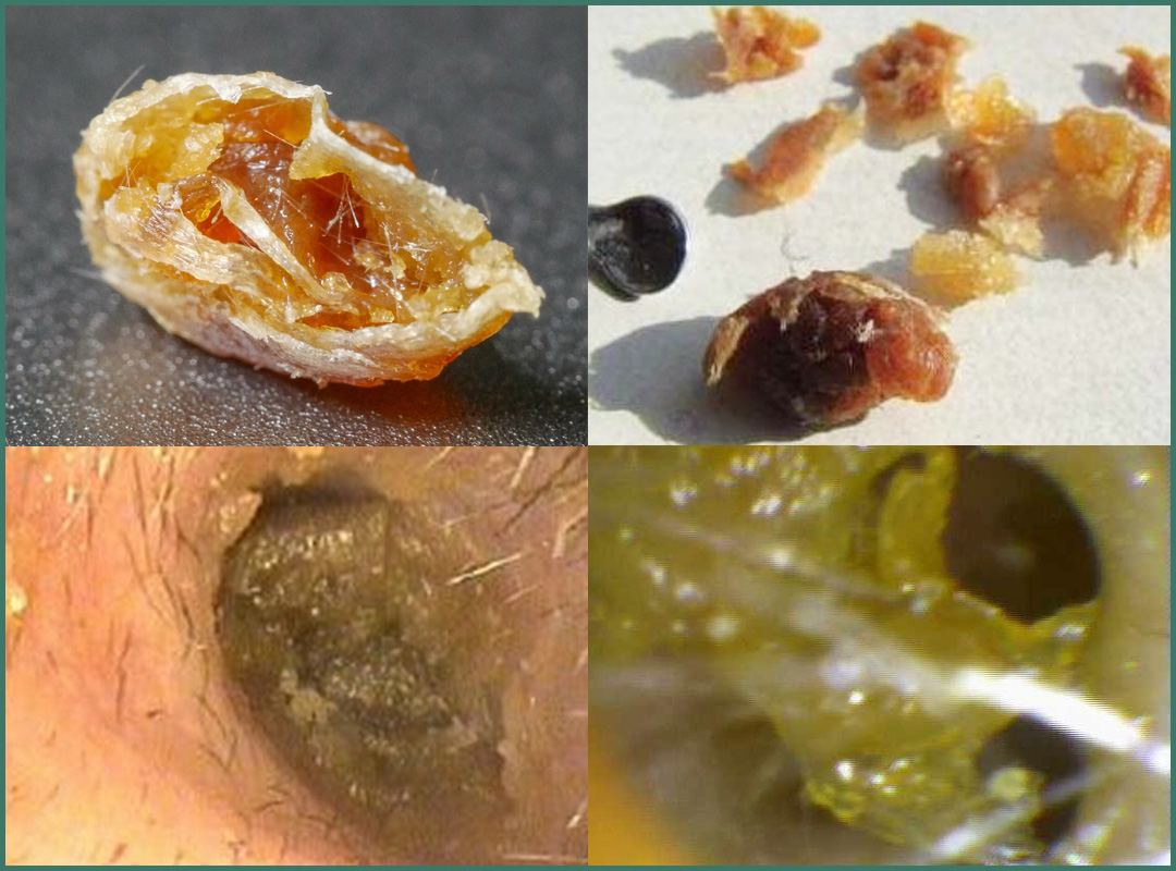 耳屎可以经常掏耳朵吗,掏耳屎的危害有多大