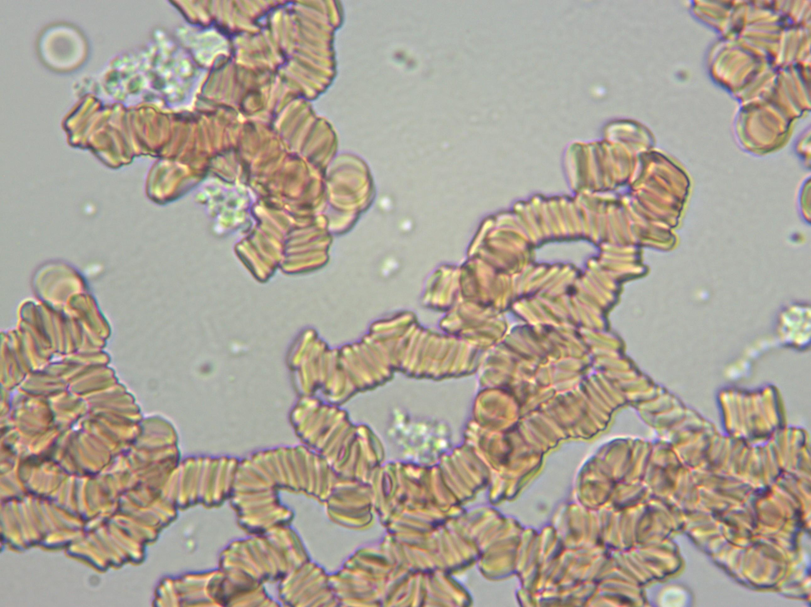 血液粘稠的病因及治疗,健康血液粘稠别小看但也别乱治