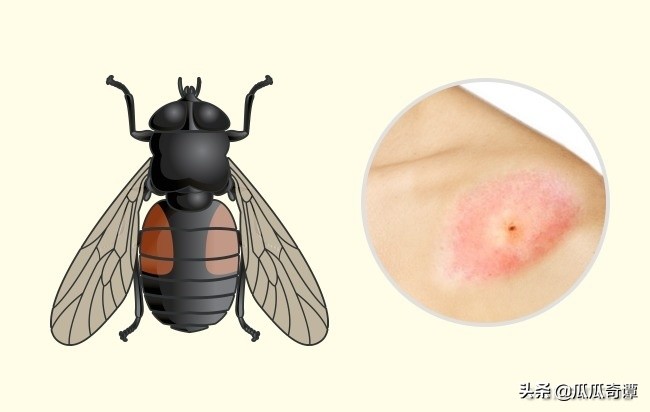 夏季蚊虫叮咬教你一招轻松解决,各种昆虫叮咬清晰图片对照表