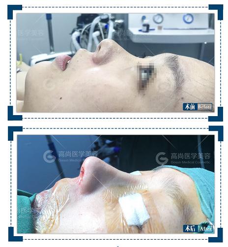 隆鼻前你必须了解的十大隆鼻问题,高级脸到底好不好