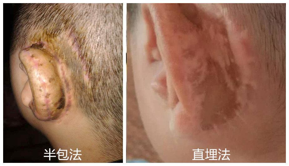 小耳症,小耳症哪里治疗比较好