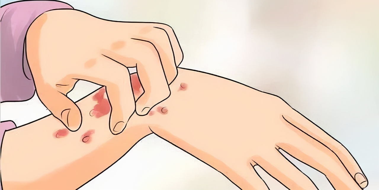 荨麻疹痒的睡不着有什么办法止痒,荨麻疹太痒了可以冷敷吗