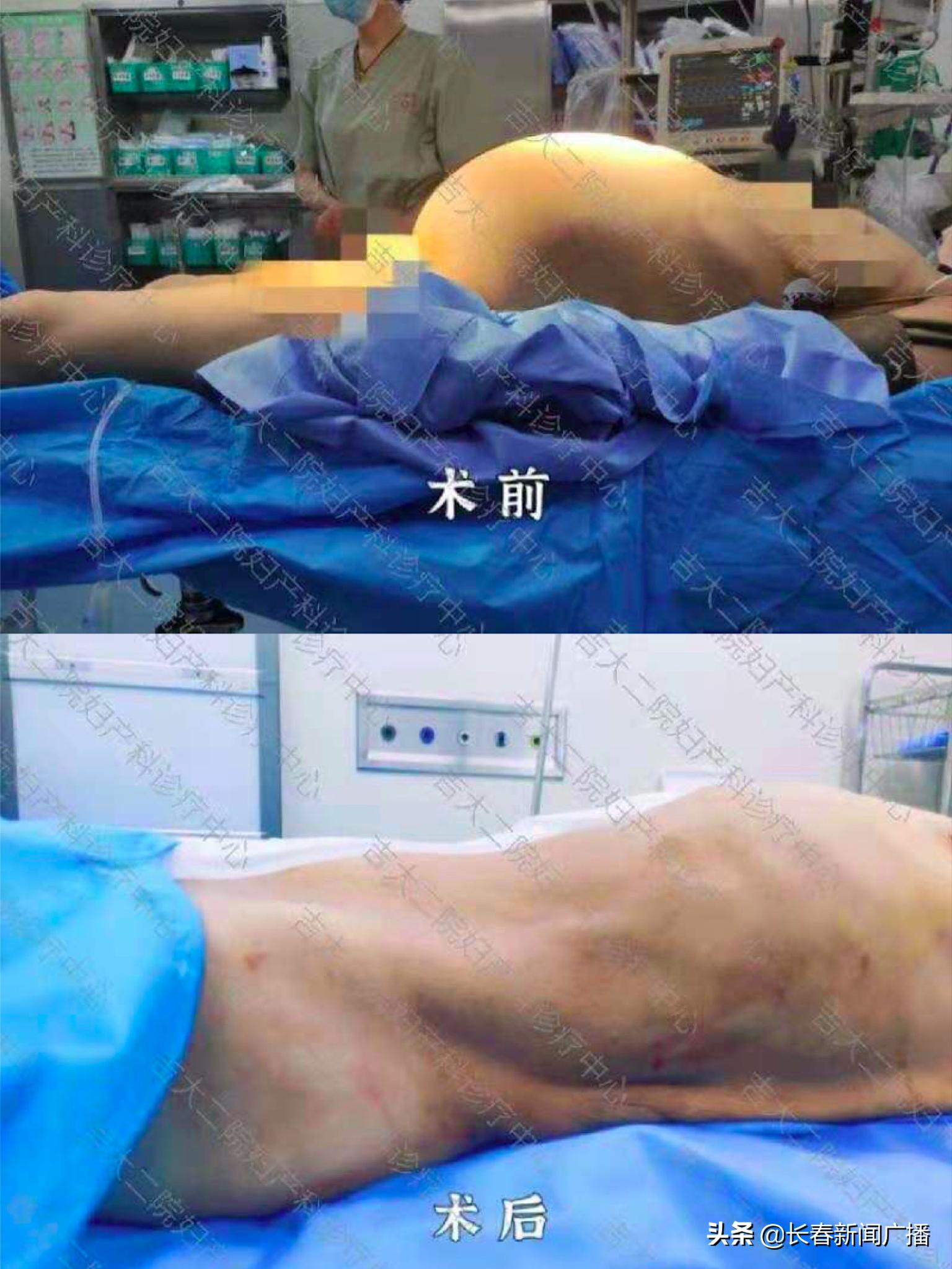 巨大肿瘤被医生成功切除,27岁女子巨大肿瘤切除手术