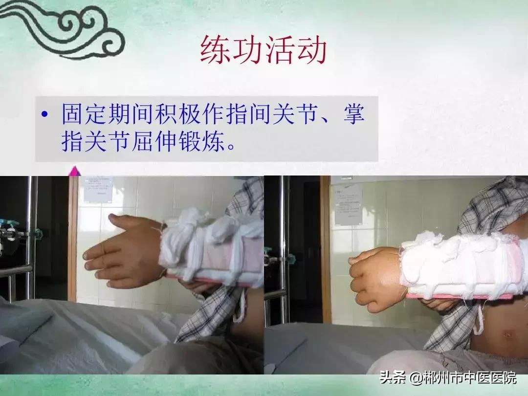 骨折后小夹板固定,骨折小夹板固定方法实操