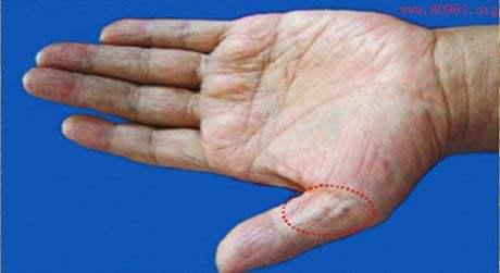 手背青筋明显是血管硬化的表现吗,血管有问题看哪个科