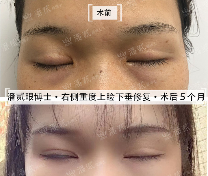 重度上睑下垂术后为什么闭不上眼睛？闭眼不全怎么护理好？