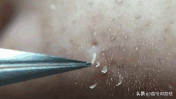 人中黑头挤完留下一个小坑,挤完黑头留下的洞洞怎么办