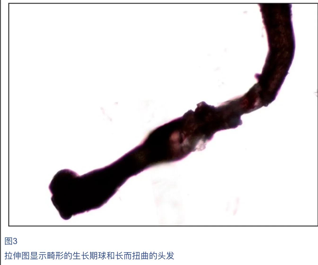 儿童脱发会是什么病的前兆,孩子毛囊引起的脱发怎么办