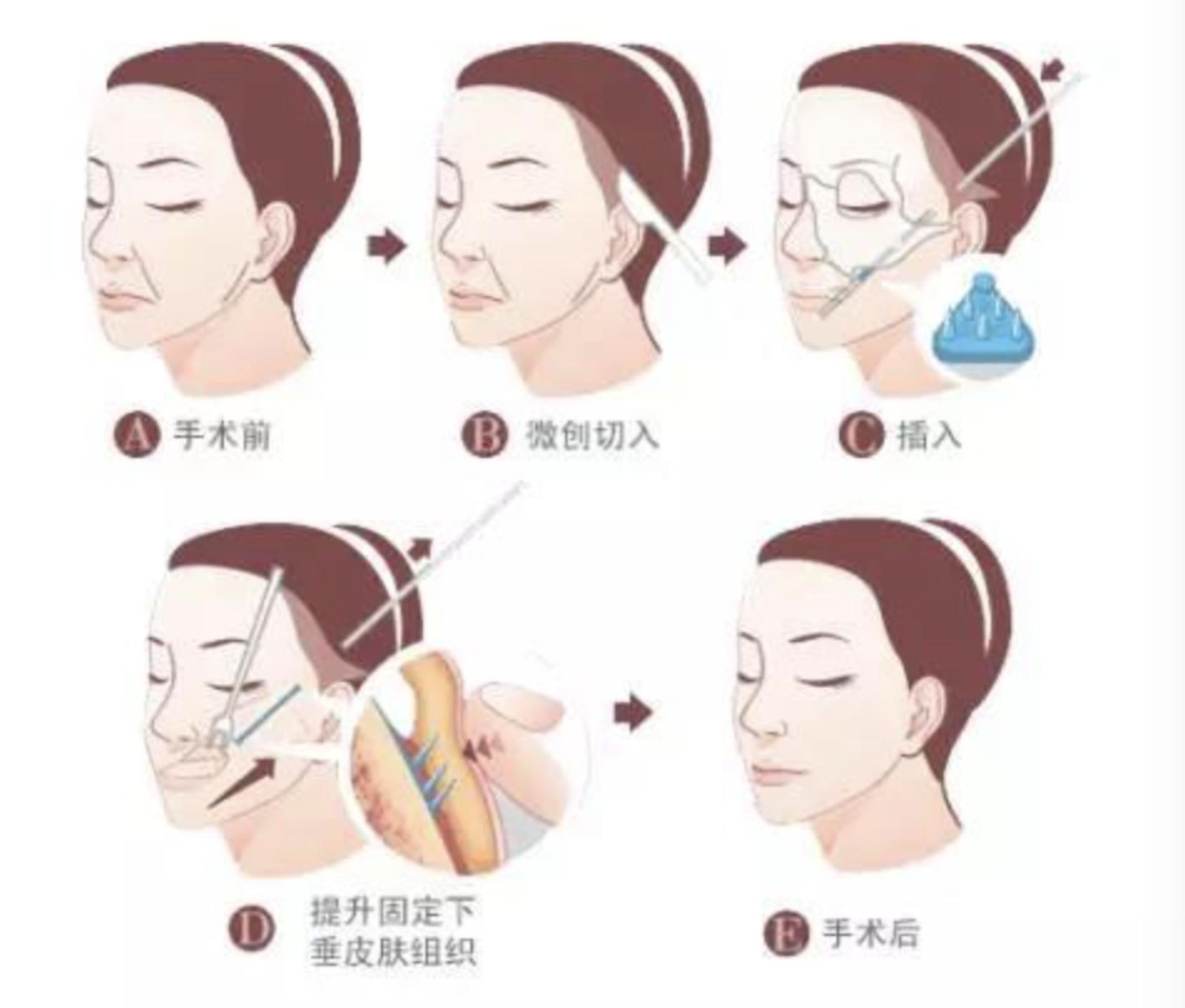 面部线雕全过程,线雕真实案例100例