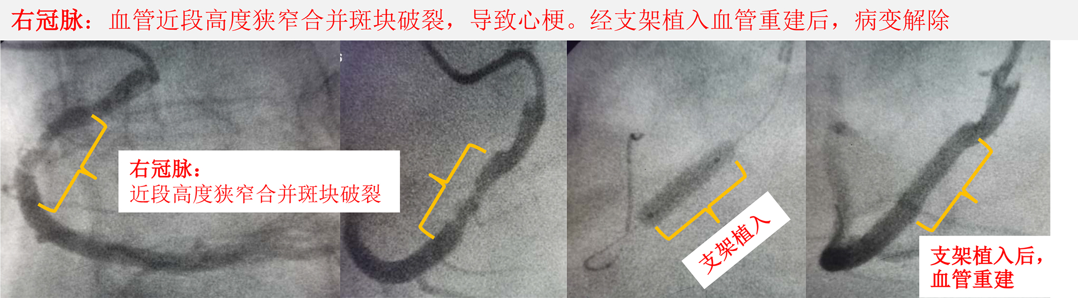 92岁心梗老人不能手术咋办,70岁冠心病植入支架以后还需住院
