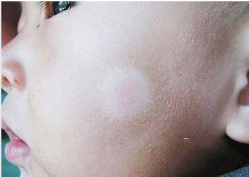 小孩身上有一块白斑怎么回事,身上有一块白斑汗毛也是白的