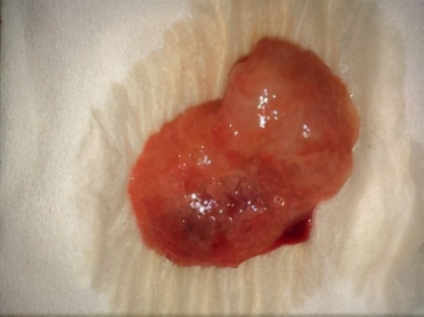 护士导致女孩意外怀孕,40岁意外怀孕做了人流