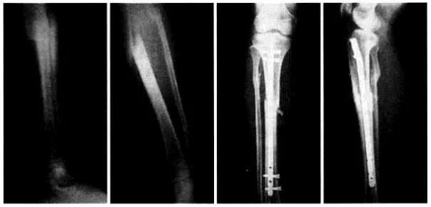 骨科髓内钉器械图谱,小儿骨科髓内钉取出术过程