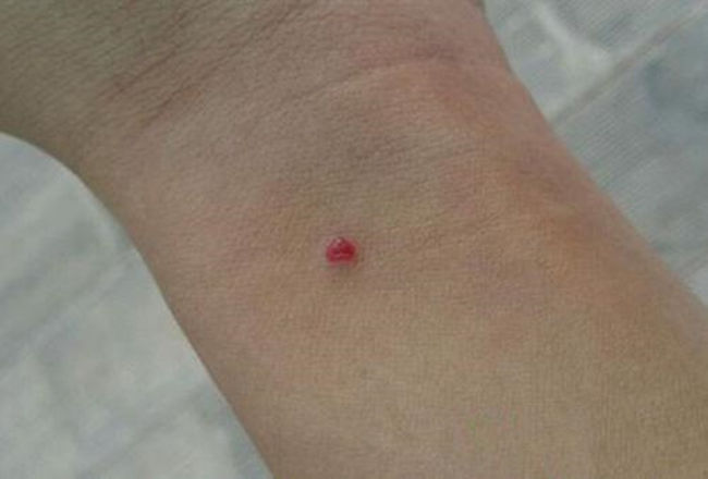 身上出现小红点一定要注意,身上的小红点是什么原因怎么治疗