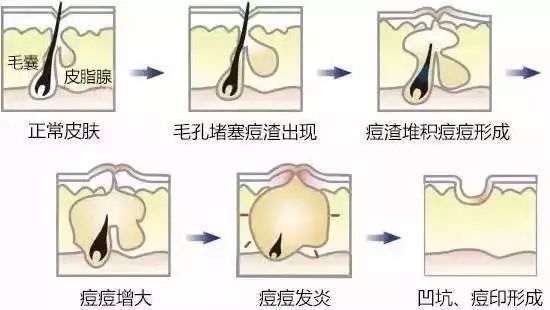 祛痘印小方法和步骤有哪些,痘印肌肤的护肤方法
