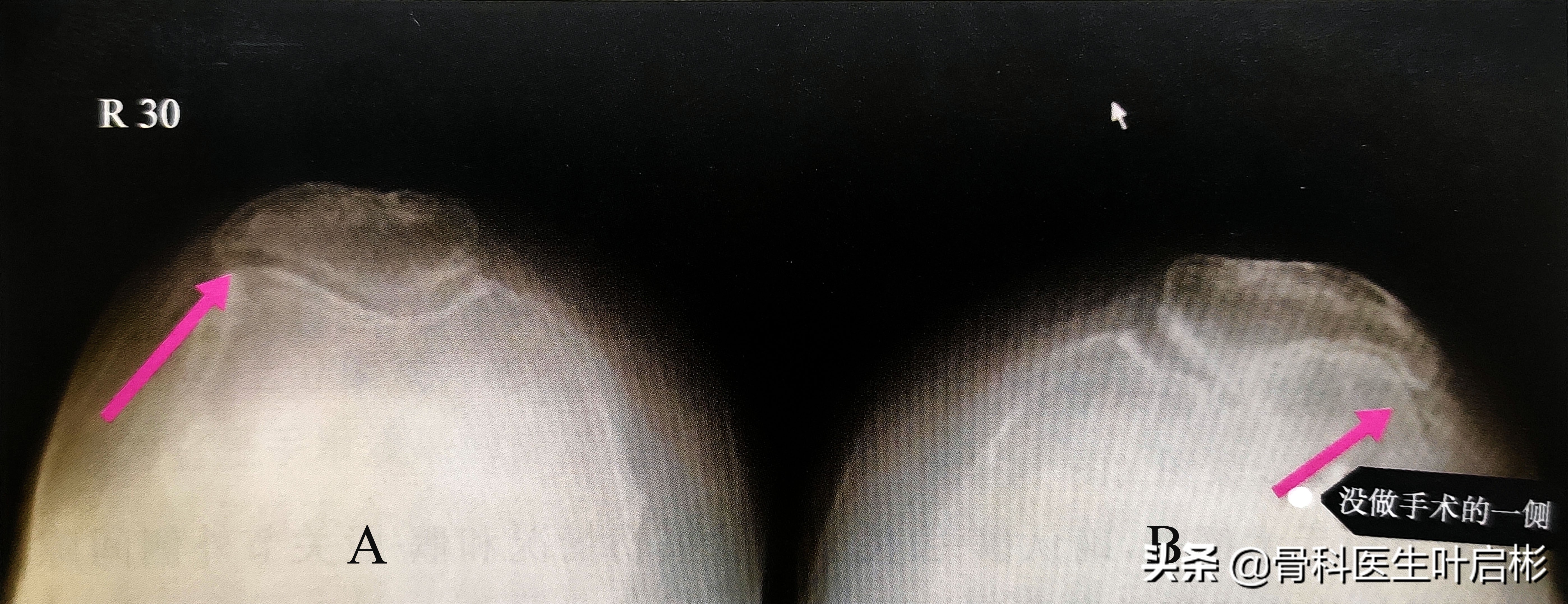 人工膝关节术中髌骨置换操作,微创手术修复关节软骨