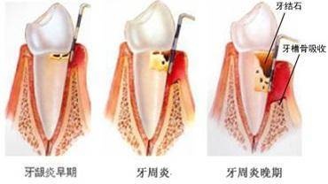 洗牙的过程是怎样的?洗牙有哪些注意事项呢?