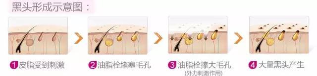 草莓鼻去黑头排行榜第一名,草莓鼻去黑头什么产品效果最佳