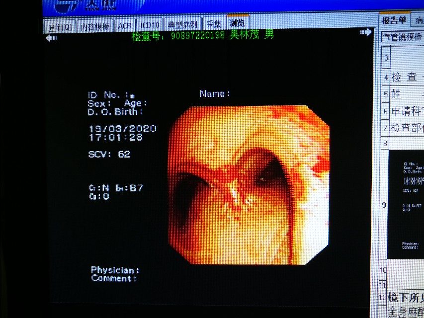 经支气管镜球囊扩张治疗气道狭窄,支气管镜球囊扩张操作视频