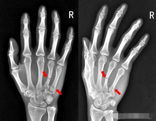 怎样发现骨折的可能性,一招看出手指骨折