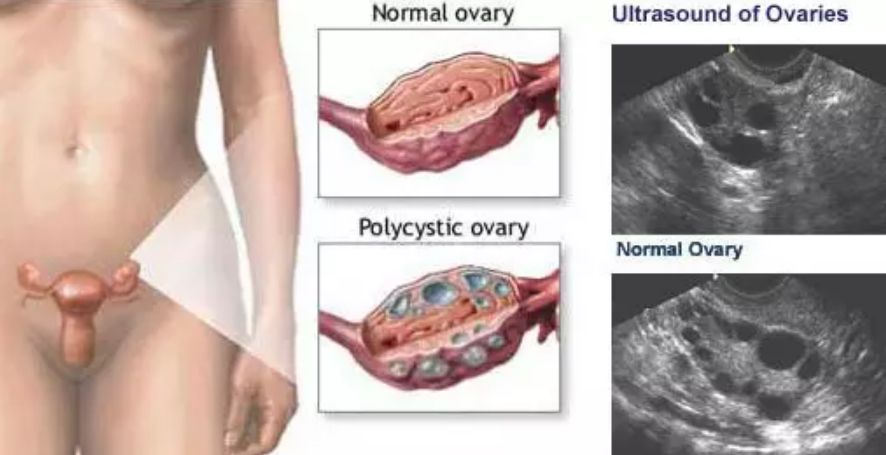 美肤霜说明书,多囊卵巢痤疮用什么药