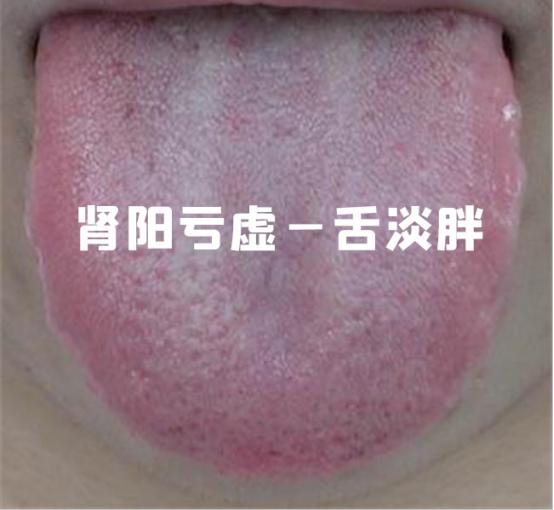 肾阴虚肾阳虚和肾精亏虚怎么分别,肾阴虚肾阳虚肾精亏有什么区别