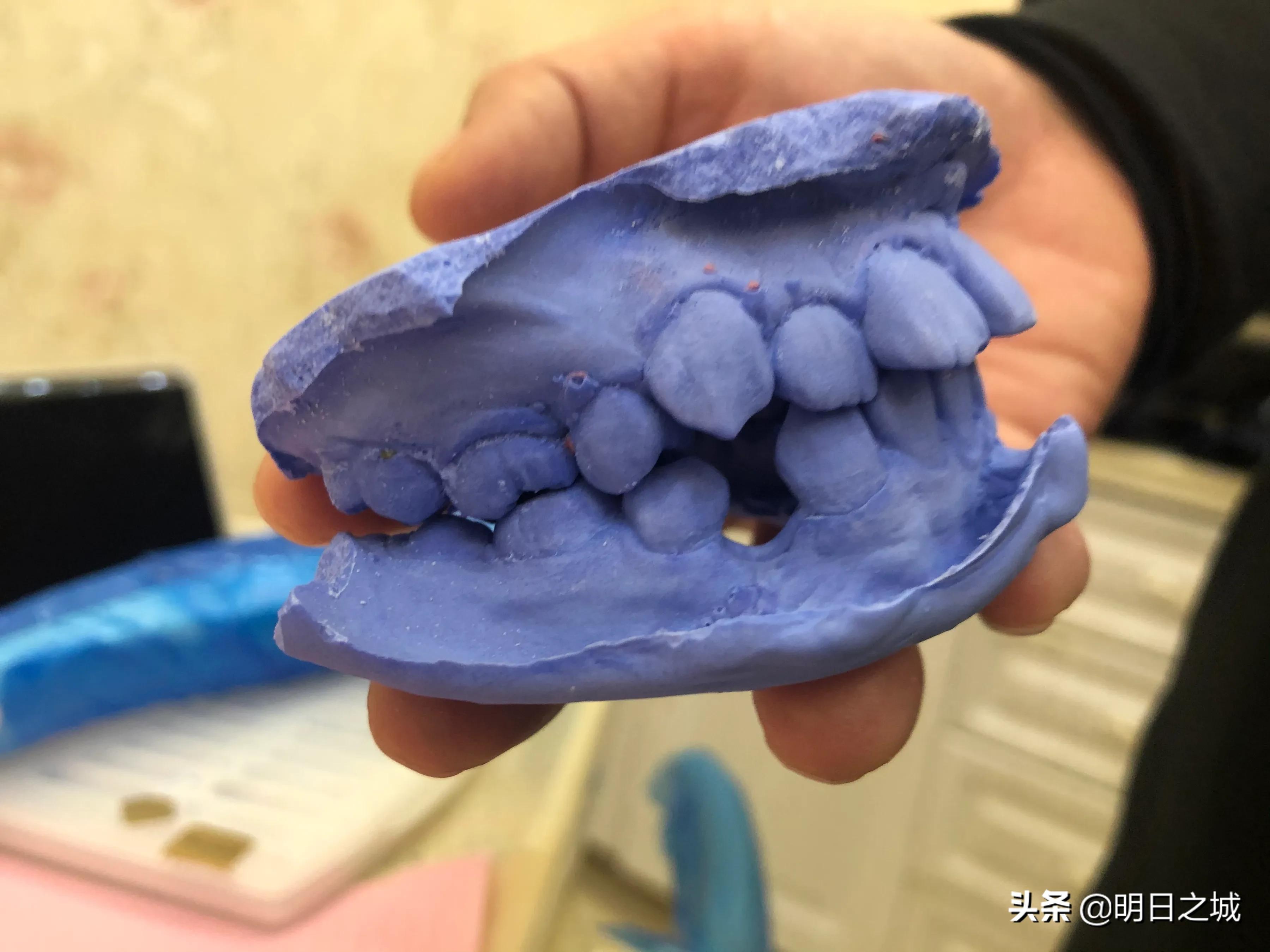 15岁女生矫正牙齿戴牙套全过程,12岁女孩牙齿矫正四颗牙一起拔牙