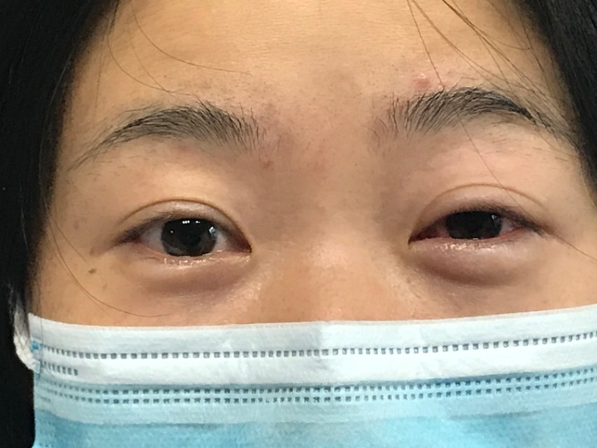 角膜上皮损伤角膜会变薄吗,角膜上皮损伤和角膜炎哪个严重