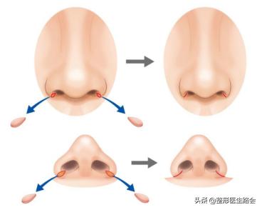 如何正确有效的缩小鼻翼,鼻翼大怎么缩小手术风险大吗