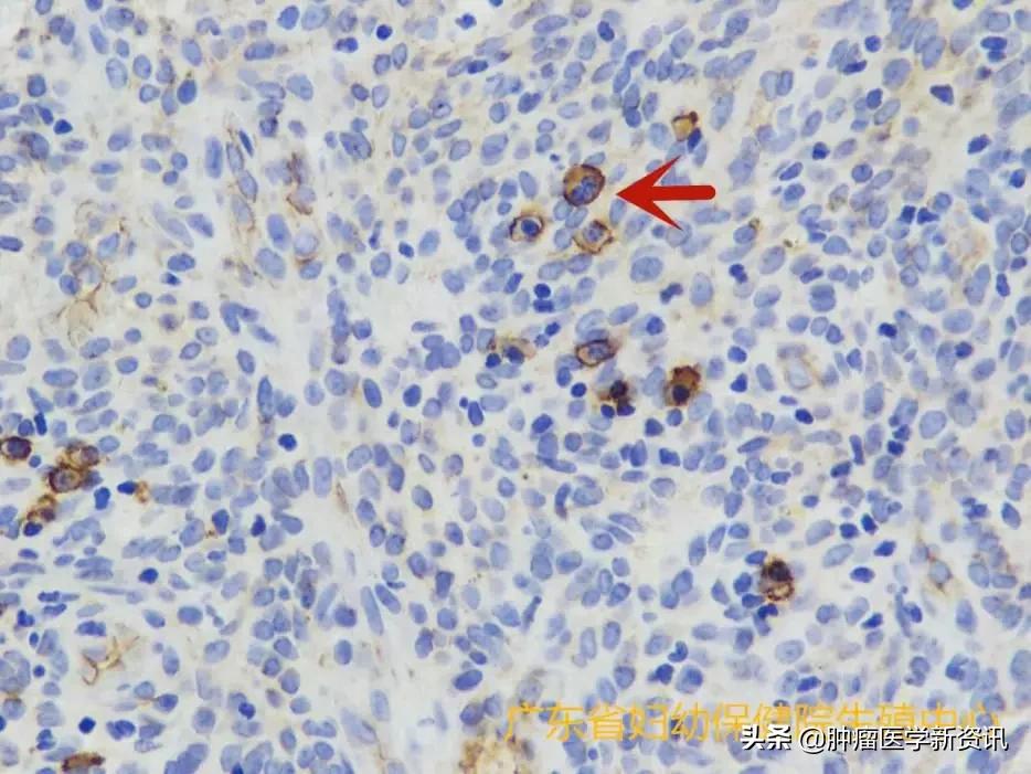 好端端的人为什么会得癌症,得了子宫内膜癌怎么办啊